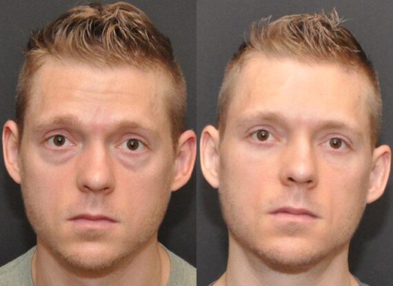 Male Plastic Surgery Before and After Photos in Cincinnati, OH, Patient 5941