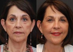 Minilift / Facelift Before and After Photos in Cincinnati, OH, Patient 5946