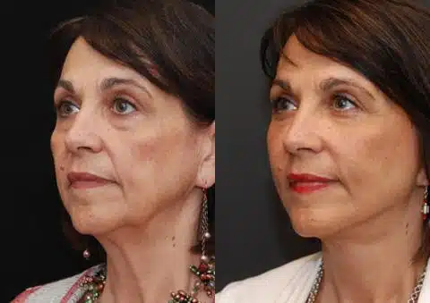 Minilift / Facelift Before and After Photos in Cincinnati, OH, Patient 5946