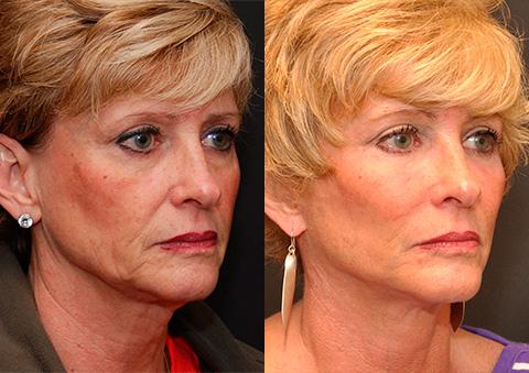 Minilift / Facelift Before and After Photos in Cincinnati, OH, Patient 6031