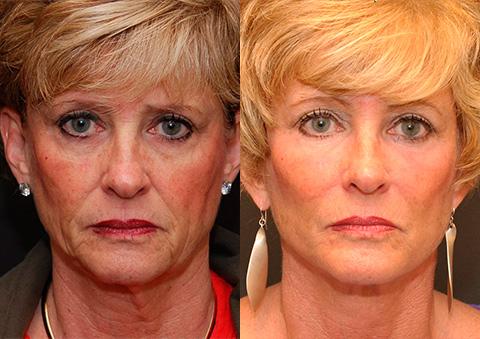 Minilift / Facelift Before and After Photos in Cincinnati, OH, Patient 6031