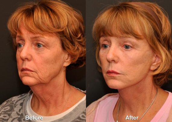 Minilift / Facelift Before and After Photos in Cincinnati, OH, Patient 6043