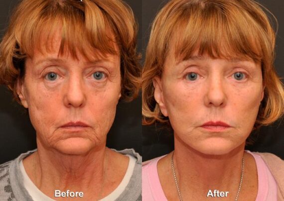 Minilift / Facelift Before and After Photos in Cincinnati, OH, Patient 6043