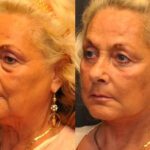 Minilift / Facelift Before and After Photos in Cincinnati, OH, Patient 6048