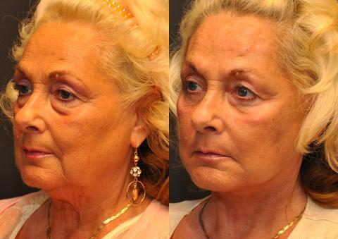 Minilift / Facelift Before and After Photos in Cincinnati, OH, Patient 6048