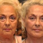 Minilift / Facelift Before and After Photos in Cincinnati, OH, Patient 6048