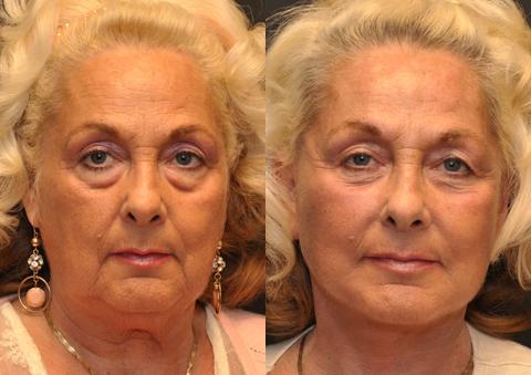 Minilift / Facelift Before and After Photos in Cincinnati, OH, Patient 6048