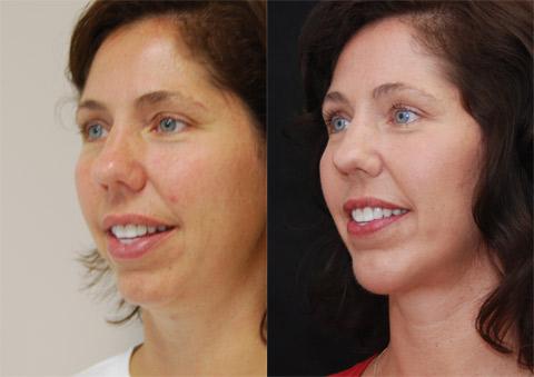 Chin Augmentation Before and After Photos in Cincinnati, OH, Patient 6056