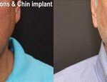 Chin Augmentation Before and After Photos in Cincinnati, OH, Patient 6062