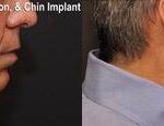 Chin Augmentation Before and After Photos in Cincinnati, OH, Patient 6062