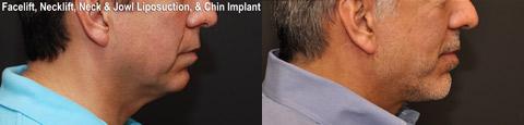 Chin Augmentation Before and After Photos in Cincinnati, OH, Patient 6062