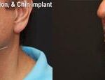 Chin Augmentation Before and After Photos in Cincinnati, OH, Patient 6062