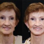 Facial Resurfacing Before and After Photos in Cincinnati, OH, Patient 6069