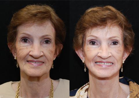 Facial Resurfacing Before and After Photos in Cincinnati, OH, Patient 6069