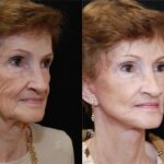 Facial Resurfacing Before and After Photos in Cincinnati, OH, Patient 6069