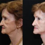 Facial Resurfacing Before and After Photos in Cincinnati, OH, Patient 6069