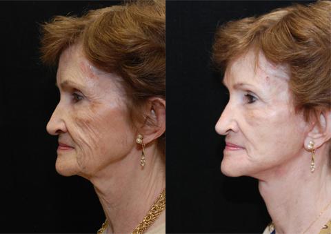 Facial Resurfacing Before and After Photos in Cincinnati, OH, Patient 6069