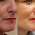 Facial Resurfacing Before and After Photos in Cincinnati, OH, Patient 6076