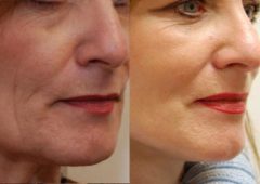 Facial Resurfacing Before and After Photos in Cincinnati, OH, Patient 6076