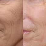 Facial Resurfacing Before and After Photos in Cincinnati, OH, Patient 6082