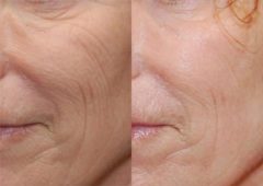 Facial Resurfacing Before and After Photos in Cincinnati, OH, Patient 6082