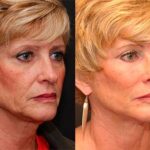 Facial Resurfacing Before and After Photos in Cincinnati, OH, Patient 6085