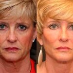 Facial Resurfacing Before and After Photos in Cincinnati, OH, Patient 6085