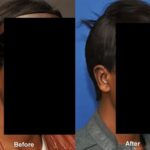 Otoplasty Before and After Photos in Cincinnati, OH, Patient 6100