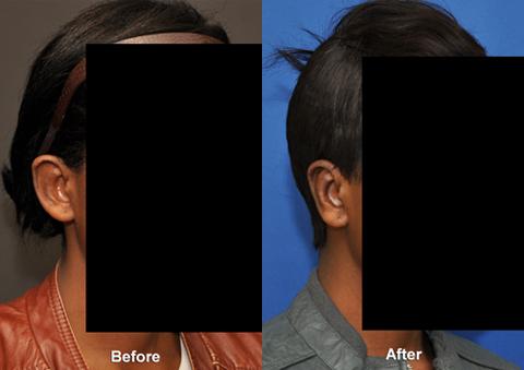 Otoplasty Before and After Photos in Cincinnati, OH, Patient 6100