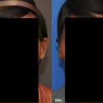 Otoplasty Before and After Photos in Cincinnati, OH, Patient 6100