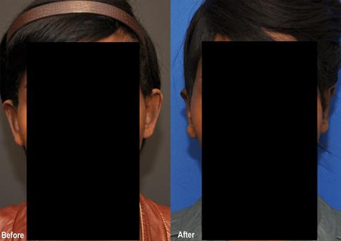 Otoplasty Before and After Photos in Cincinnati, OH, Patient 6100