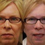 Reconstructive / Other Before and After Photos in Cincinnati, OH, Patient 6110