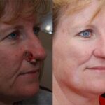 Reconstructive / Other Before and After Photos in Cincinnati, OH, Patient 6115