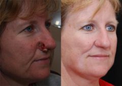 Reconstructive / Other Before and After Photos in Cincinnati, OH, Patient 6115