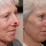 Reconstructive / Other Before and After Photos in Cincinnati, OH, Patient 6118