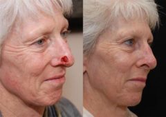 Reconstructive / Other Before and After Photos in Cincinnati, OH, Patient 6118