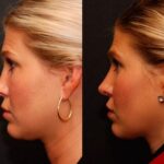 Revision Rhinoplasty Before and After Photos in Cincinnati, OH, Patient 6124