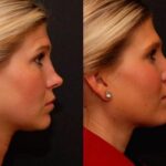 Revision Rhinoplasty Before and After Photos in Cincinnati, OH, Patient 6124