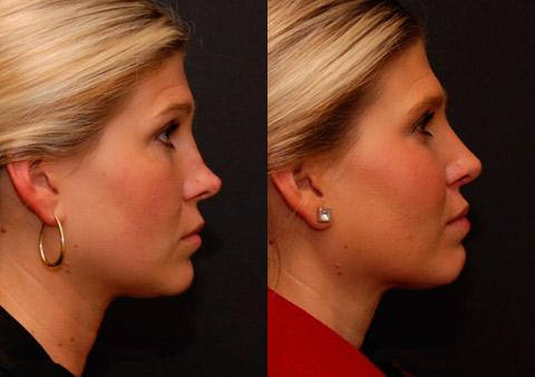 Revision Rhinoplasty Before and After Photos in Cincinnati, OH