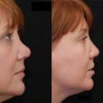 Revision Rhinoplasty Before and After Photos in Cincinnati, OH, Patient 6129