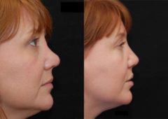 Revision Rhinoplasty Before and After Photos in Cincinnati, OH, Patient 6129