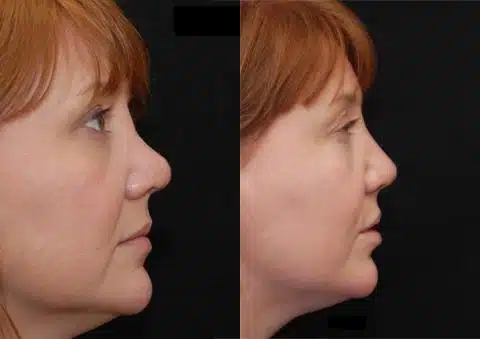 Revision Rhinoplasty Before and After Photos in Cincinnati, OH, Patient 6129