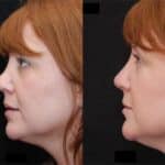 Revision Rhinoplasty Before and After Photos in Cincinnati, OH, Patient 6129