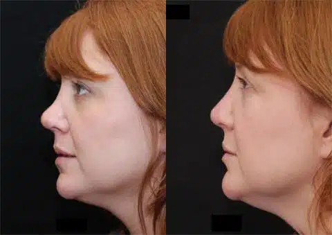 Revision Rhinoplasty Before and After Photos in Cincinnati, OH, Patient 6129