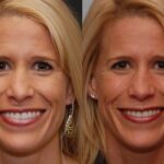Revision Rhinoplasty Before and After Photos in Cincinnati, OH, Patient 6134
