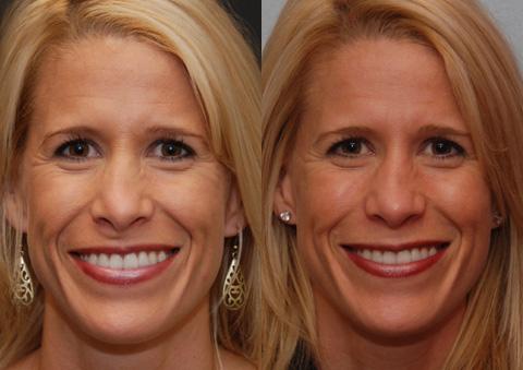 Revision Rhinoplasty Before and After Photos in Cincinnati, OH, Patient 6134