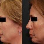 Revision Rhinoplasty Before and After Photos in Cincinnati, OH, Patient 6139