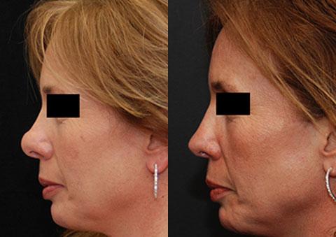 Revision Rhinoplasty Before and After Photos in Cincinnati, OH, Patient 6139