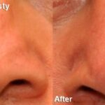 Revision Rhinoplasty Before and After Photos in Cincinnati, OH, Patient 6147