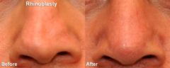 Revision Rhinoplasty Before and After Photos in Cincinnati, OH, Patient 6147